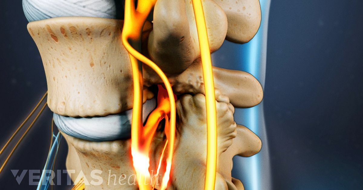 spinal stenose